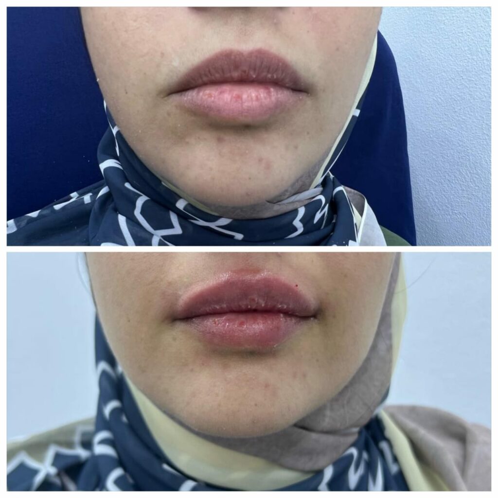 حقن الهيالورونيك في الغردقة والبحر الأحمر